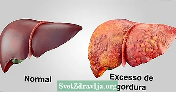 Steatosis ati: apa, gejala, derajat lan perawatan