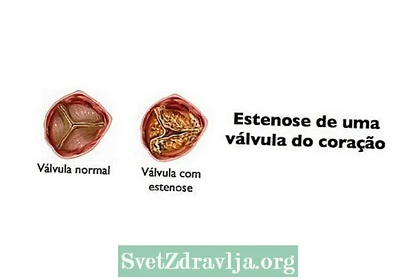 I-aortic stenosis: kuyini, izimpawu nokwelashwa