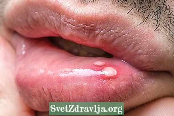 Viêm miệng: nó là gì, nguyên nhân, triệu chứng chính và cách điều trị