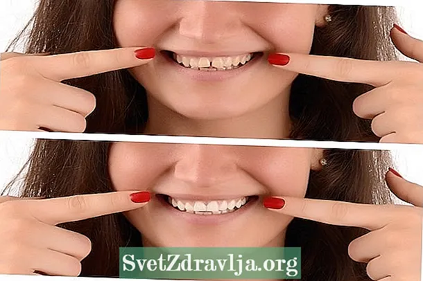 Zobne luske iz smole ali porcelana: prednosti in slabosti