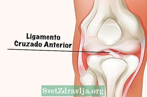 Physiotherapy para sa Knee Ligament Rupture (ACL)