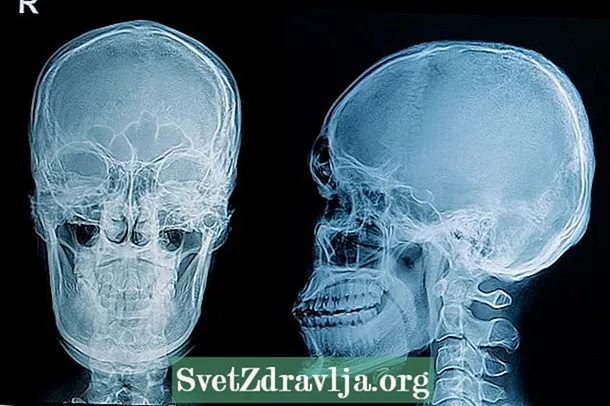 頭蓋骨折：それが何であるか、症状と治療
