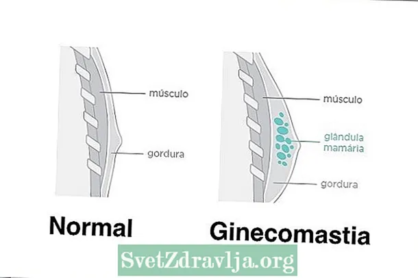 Gynecomastia: apa sebabe, sebab lan cara ngenali