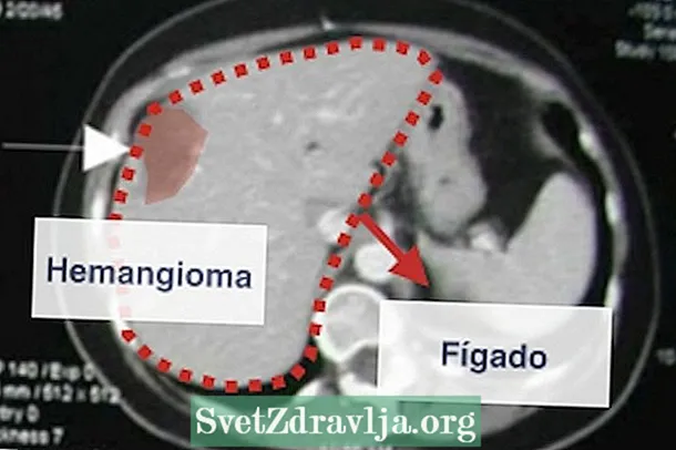 肝血管瘤（肝）：是什么，症状和如何治疗