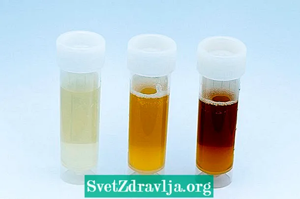 Reade bloedsellen yn 'e urine: wat it betsjut en hoe it te behanneljen