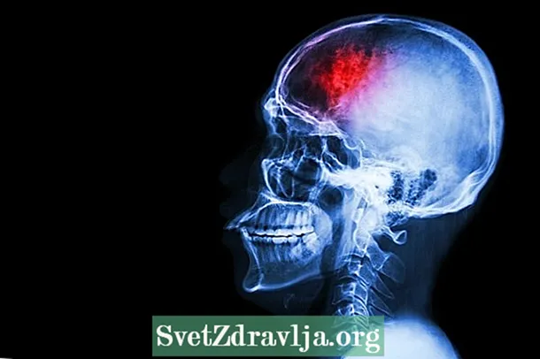 뇌출혈 : 증상, 원인 및 가능한 후유증