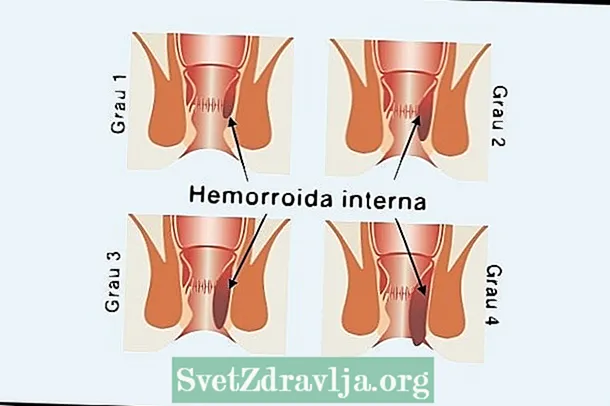 Hemorroide të brendshme: cilat janë ato, simptomat kryesore dhe gradat - Durim