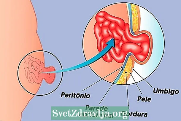 Epigastric hernia: unsa kini, mga simtomas, hinungdan ug pagtambal - Panglawas