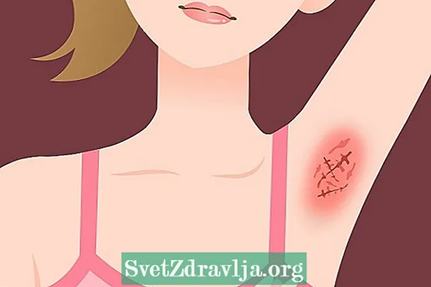 I-Hidradenitis suppurativa (i-reverse acne): iimpawu eziphambili kunye nendlela yokunyanga
