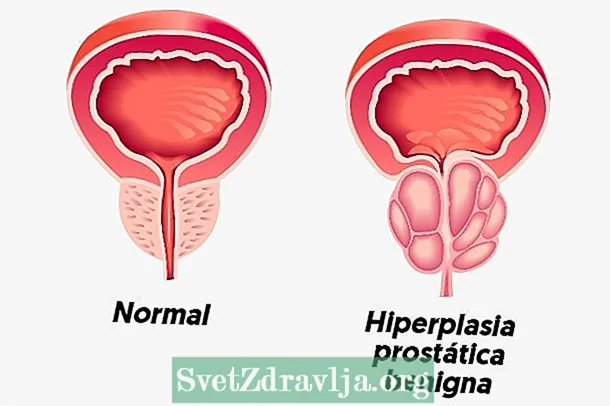 Benign Prostatic hyperplasia: ndi chiyani, zizindikiro, zoyambitsa ndi chithandizo
