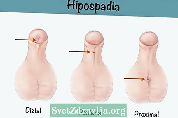 हाइपोस्पेडिया: यह क्या है, प्रकार और उपचार