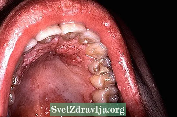 VPH in bocca: sintomi, trattamentu è modi di trasmissione