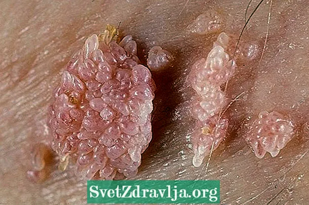 Ерлердегі HPV: белгілері, оны қалай алуға болады және емдеу