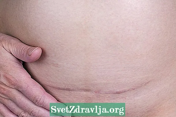 Ernia incisionale: cos'è, sintomi, cause e trattamento