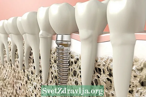 Implant dentaire: qu'est-ce que c'est, quand le mettre et comment le faire