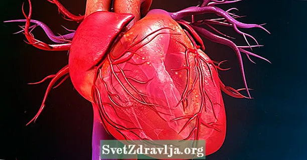 Cardiac ischemia: ihe ọ bụ, isi mgbaàmà na ọgwụgwọ
