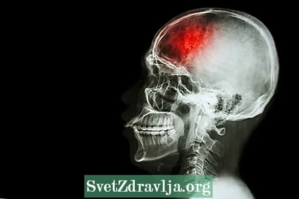 Ischémie cérébrale: qu'est-ce que c'est, symptômes et traitement