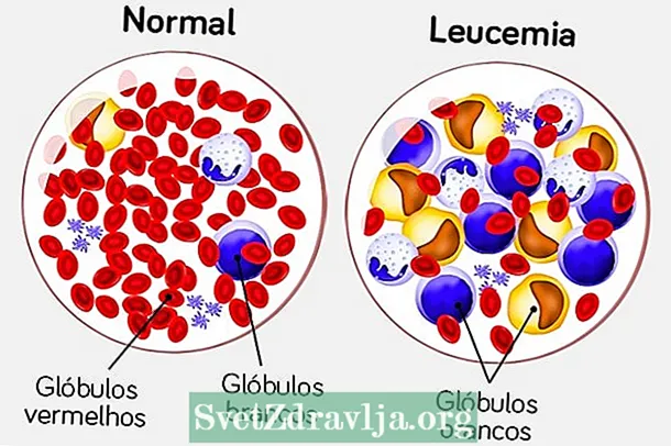 Leukemia Lymphoid: inona izany, ireo soritr'aretina lehibe ary ny fomba hitsaboana - Fahasalamana