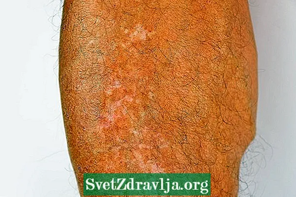Leucoderma gutata (freckles putih): apa lan cara ngobati - Kesehatan