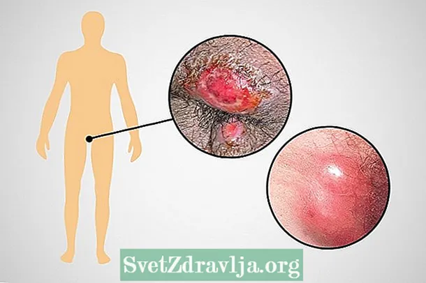 I-venereal lymphogranuloma (LGV): yintoni, iimpawu kunye nonyango - Zempilo