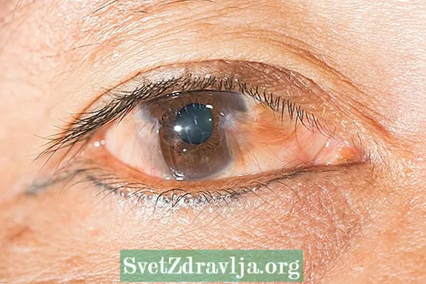 Mancha amarilla en el ojo: 3 causas principales y que hacer