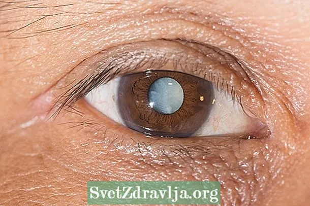 Бело дамка на окото: што може да биде и кога да се оди на лекар