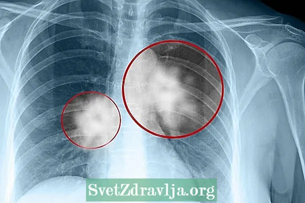 נקודה על הריאה: 4 סיבות אפשריות ומה לעשות