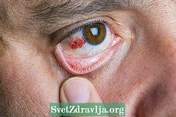 Crvena mrlja na oku: 6 mogućih uzroka i šta treba učiniti