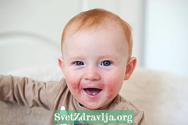 婴儿身上的红斑：怎么办以及如何治疗