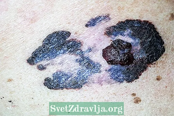 I-Metastatic melanoma: yintoni, iimpawu kunye nendlela ephathwa ngayo