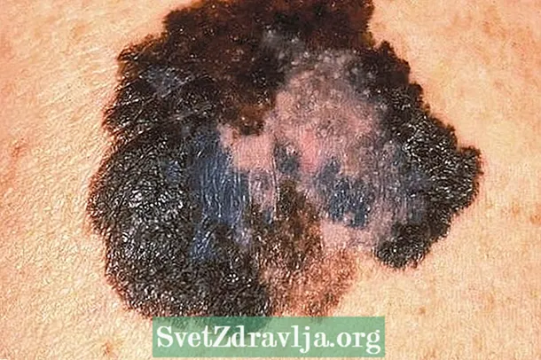 Melanoma: unsa kini, panguna nga lahi ug pagtambal