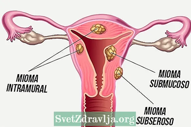 Intramuralis mióma: mi ez, tünetei, okai és kezelése