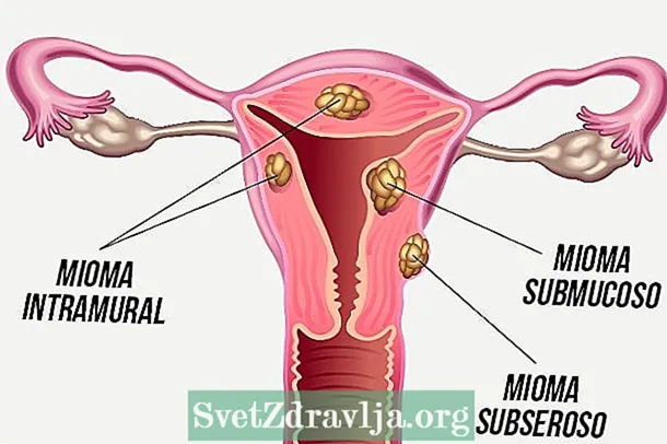 Myoma: וואָס עס איז, ז און באַהאַנדלונג