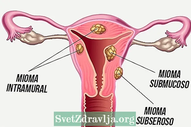 Submucous fibroid: yintoni, ziindidi, iimpawu kunye nonyango - Zempilo