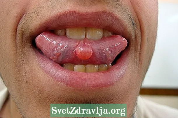 Mucocele (blister i munden): hvad det er, hvordan man identificerer og behandling