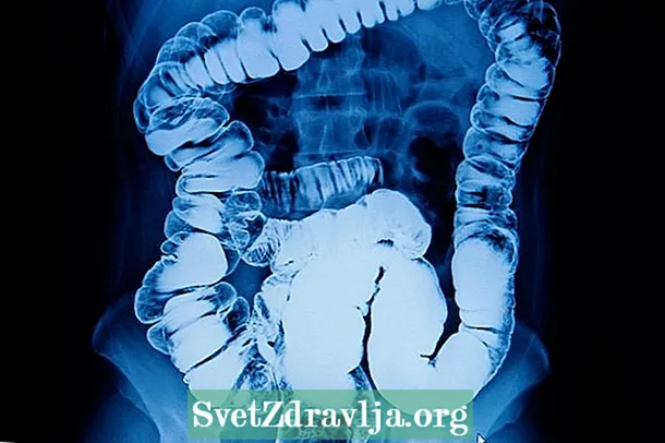 Nút trong ruột (volvo): nó là gì, triệu chứng và điều trị - Sự KhỏE KhoắN
