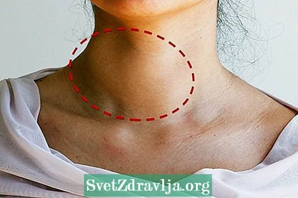 Ang thyroid nodule: unsa kini, mga simtomas ug pagtambal