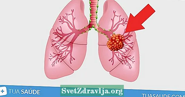 Gendheng ing paru-paru: apa tegese lan kapan kanker