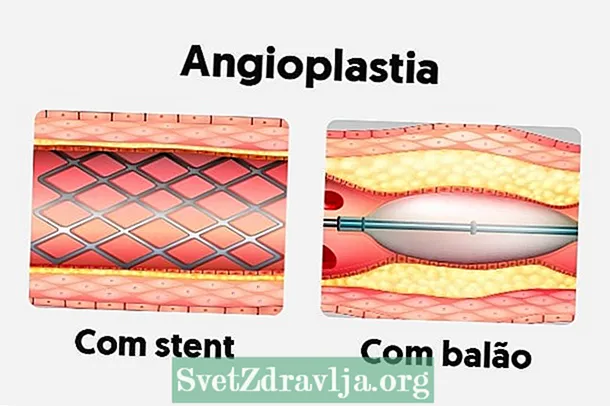 Wat is Angioplasty en hoe wurdt it dien?
