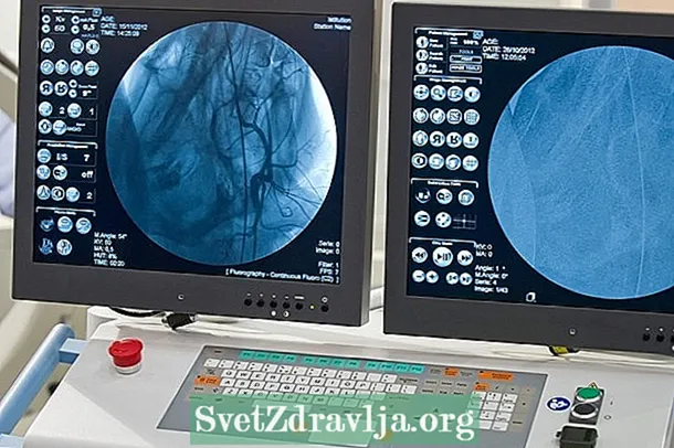 Chii chinonzi arteriography uye bvunzo inoitwa sei - Utano