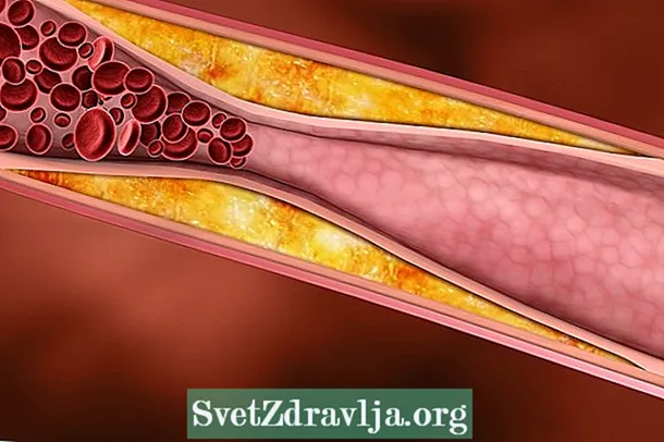 Šta je aortna ateromatoza, simptomi i kako liječiti