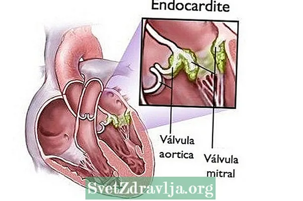 Naon endokarditis baktéri sareng naon gejalana - Kasehatan