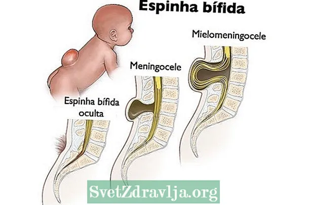 Spina bifida ni nini na matibabu hufanywa vipi