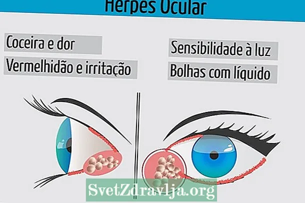 Mis on herpes silmades, kuidas seda saada ja kuidas seda ravida