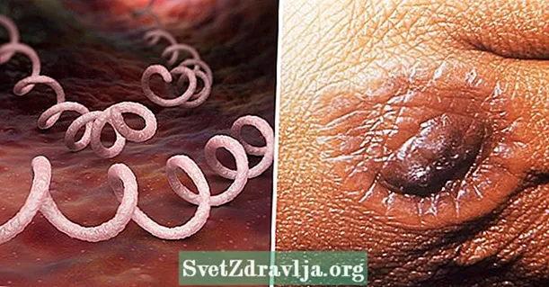 Vad är syfilis och huvudsymptom