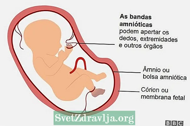 Qu'est-ce que le syndrome de la bande amniotique, ses causes et comment le traiter