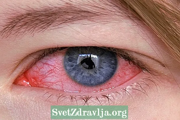 Was ist Augentuberkulose, Symptome und wie zu behandeln