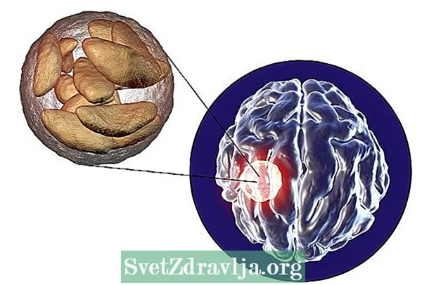 脳膿瘍とは何ですか？