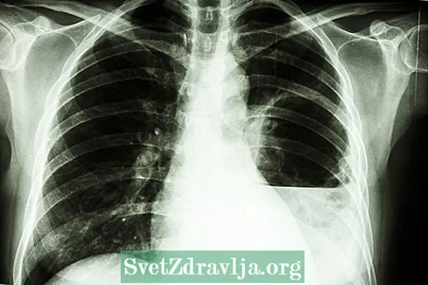 Que é o absceso pulmonar, os síntomas, as causas e como tratar - Saúde