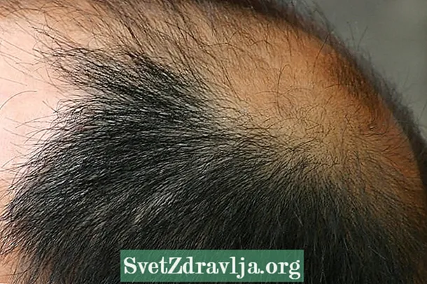 Alopecî çi ye, sedemên sereke, çawa tê naskirin û dermankirin - Tendûrûstî